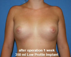 plastic-surgery-breast-augmentation